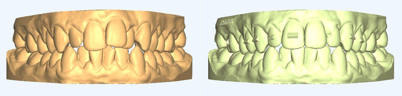 Aligner